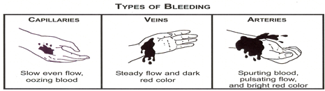 typesofbleeding.png from http://www.gwinnettcounty.com/cgi-bin/gwincty/egov/ep/gcbrowse.do?channelId=-536881926&pageTypeId=536880236